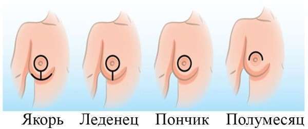 Методы подтяжки груди. Виды операции, как делается, фото до и после