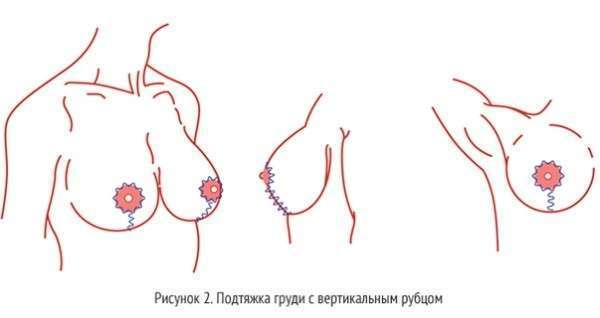 Методы подтяжки груди. Виды операции, как делается, фото до и после