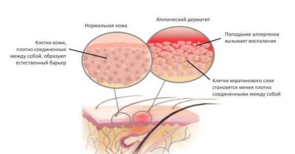 Роль витамина D в лечении атопического дерматита