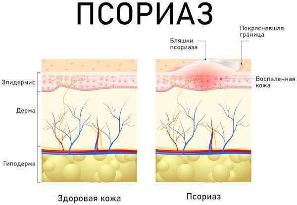 Сухая кожа рук. Что делать, мазь, средства от сухости, уход дома