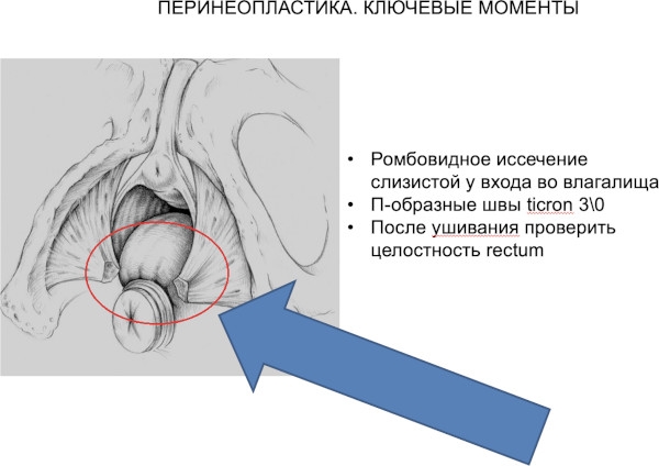 Перинеопластика (пластика промежности). Что это, цена