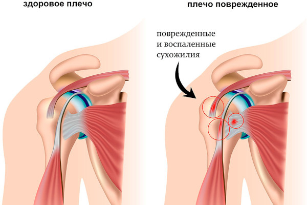 Тяга верхнего блока к груди широким хватом. Техника