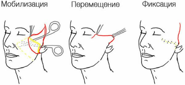 Лифтинг Мендельсона (спейслифтинг). Что это такое, фото до, после, цена