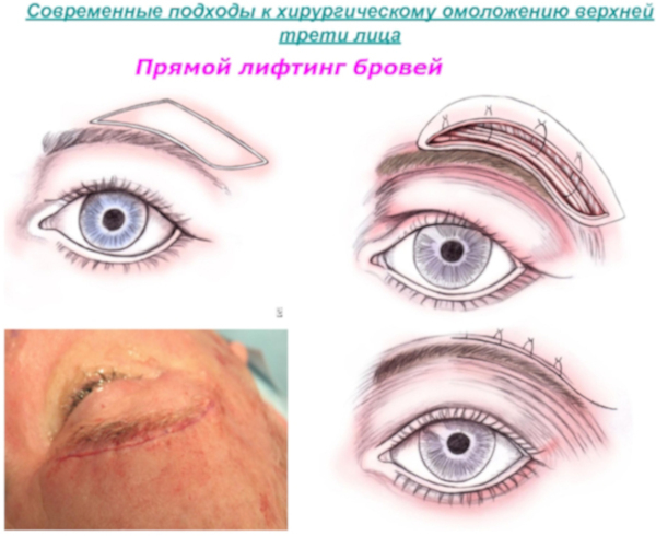 Операции по подтяжке бровей (лифтинг). Фото до и после, отзывы